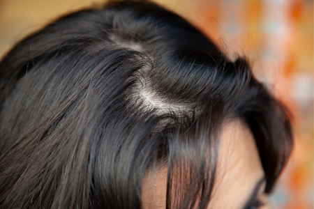 Scalp Pigmentation