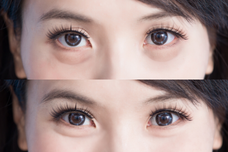 undereyes